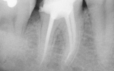 Endodoncie 2